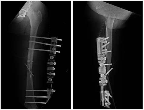 Immediate Postoperative Radiographs Show Reduction Of Fractured Femur