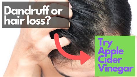 Apple Cider Vinegar For Dandruff Itchy Scalp And Hair Loss Treatment Verdict Youtube