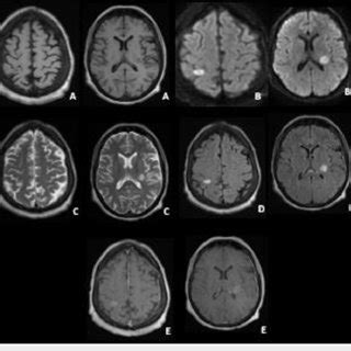 Brain Magnetic Resonance Imaging 1 5 Tesla A T1 Axial View B