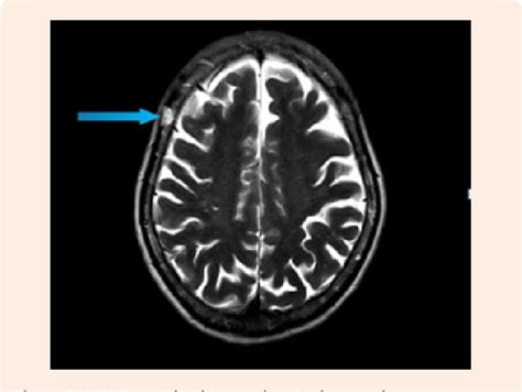 Figure From Multifocal Cavernous Hemangiomas Of The Skull Presenting