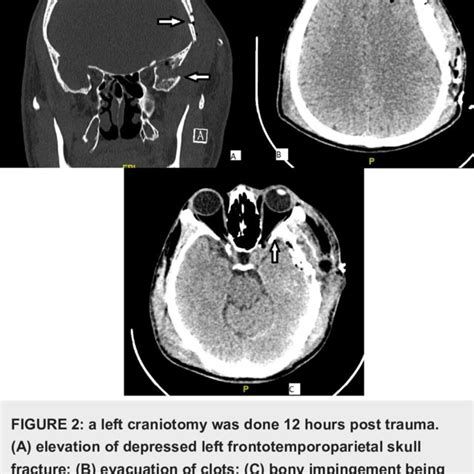 (A,B) left greater wing of sphenoid bone fracture with a bony spur ...