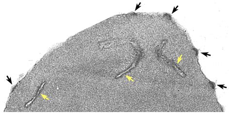 Tropicalmed Free Full Text Knobs Adhesion And Severe Falciparum Malaria