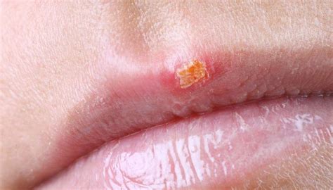 Cold Sores Are Highly Infectious Blisters That Develop On The Lips And