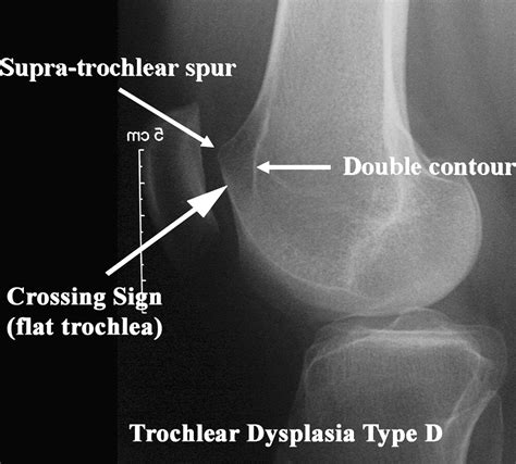 The Pathophysiology Of Patellofemoral Arthritis Orthopedic Clinics