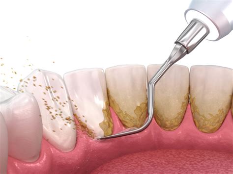 Periodontal Procedures Perioclinik Dr Freddy Fokam