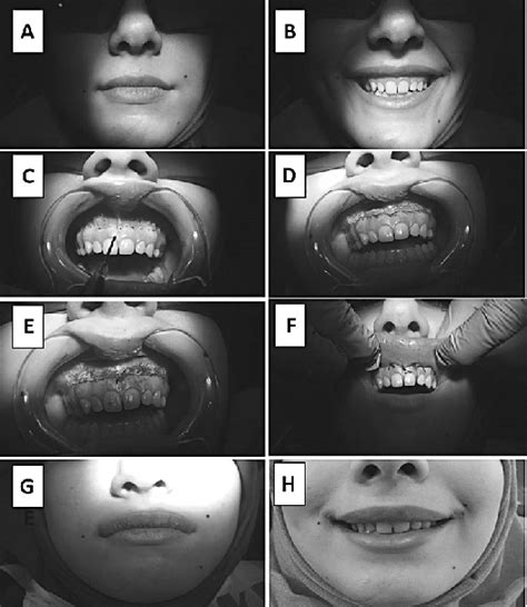 A B Preoperative Anterior View Of The Patient Closed Mouth