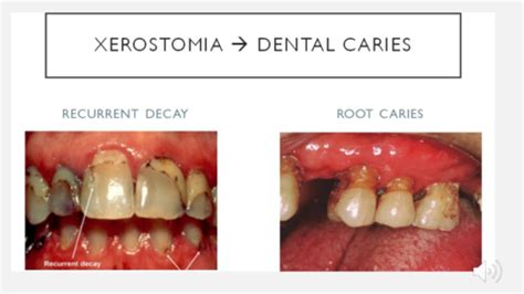 Geriatrics Lecture Caries Management Flashcards Quizlet