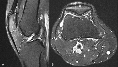 Full Article Morphologic Evaluation Of The Patella The Impact Of