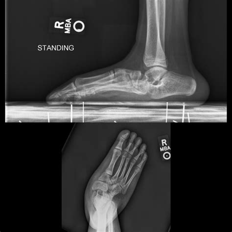 Figure Congenital Vertical Talus Vertical Orientation