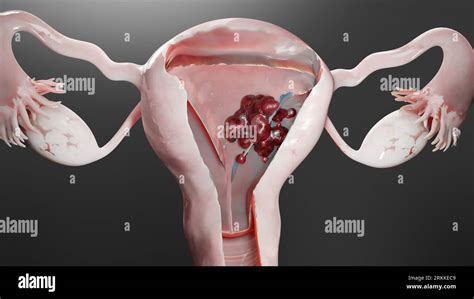 Tumore Maligno Dell Utero Anatomia Femminile Dell Utero Sistema