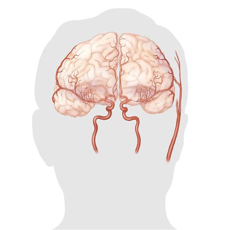 Moyamoya Disease Toronto Neurovascular Group