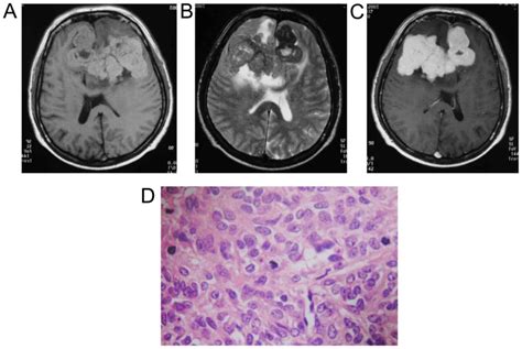 Mri Features Of Intracranial Anaplastic Hemangiopericytoma