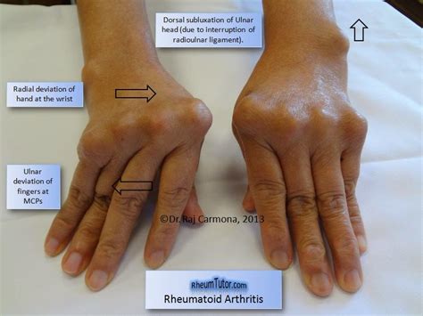 144 Penyakit Arthritis Reumatoid