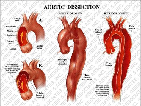 Aortic Dissection Jodie Jack