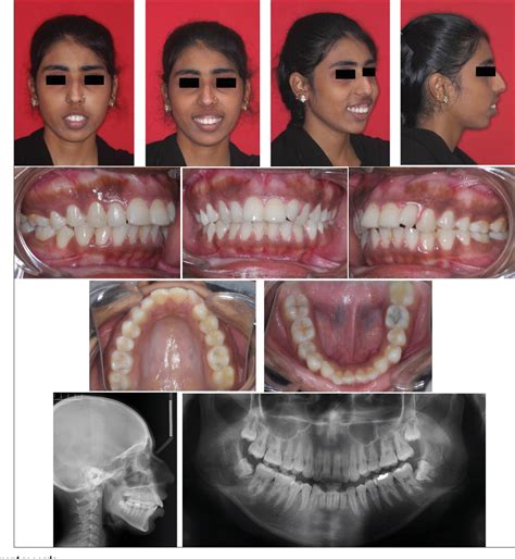 Figure 1 From Surgical Management Of Hyperdivergent Class Ii Malocclusion With Vertical