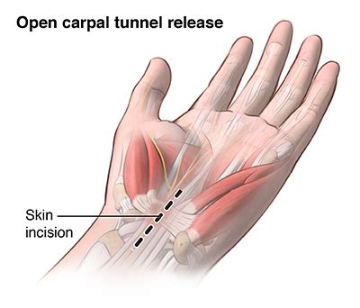 Carpal Tunnel Decompression