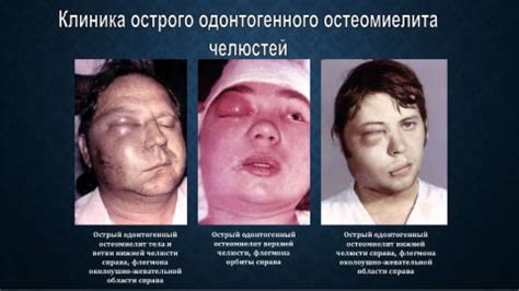 Остеомиелит челюсти | Хорошая Стоматология