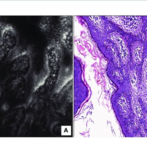 Solitary Mastocytoma A Rcm At The Level Of Dermoepidermal Junction