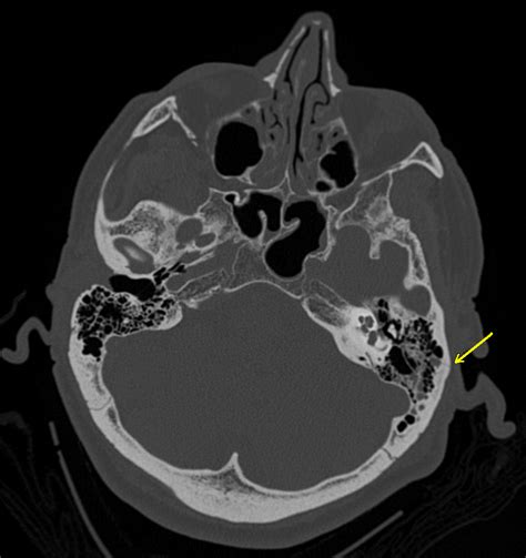 Skull fracture, basilar; Basilar Skull Fracture; Battle Sign