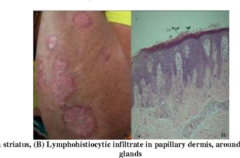 Figure 4 From Study Of Clinico Histopathological Correlation Of