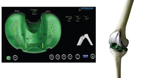 New Sensor Enhances Precision Balance During Total Knee Replacement