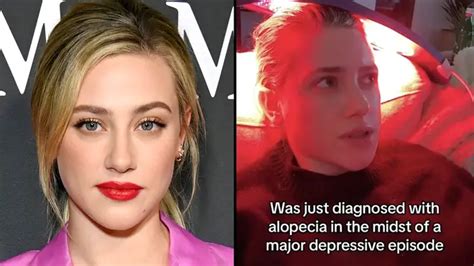 Lili Reinhart Shares She Has Been Diagnosed With Alopecia Popbuzz