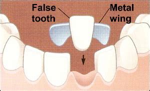 Maryland Bridge | Cosmetic Dentistry