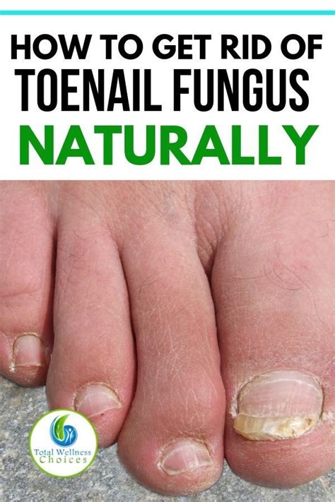 Looking For How To Get Rid Of Toenail Fungus Fast And Naturally Here Are 9 Simple Natural