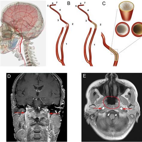 A Schematic Diagram Of The Internal Carotid Artery In The Human Body Download Scientific