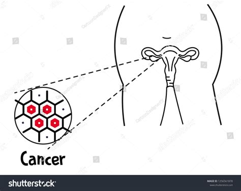 Illustration Ovarian Cancer Ovary Cyst Cancer Stock Vector Royalty Free 1256561878 Shutterstock