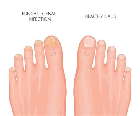 Yellow Toenails What They Say About Your Health And How To Treat Them