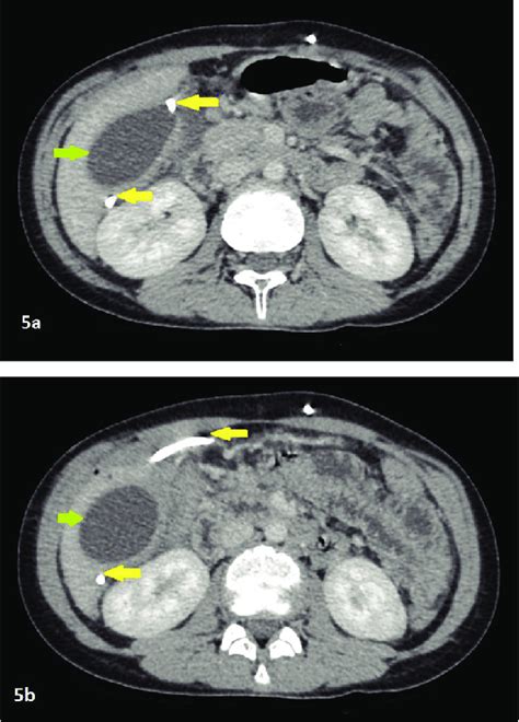 A5b Axial Sections Of Cect Abdomen At Venous Phase Shows A Well Download Scientific Diagram