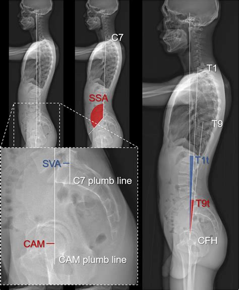 The Graph Shows How Whole Body Sagittal Spinopelvic Parameters Were