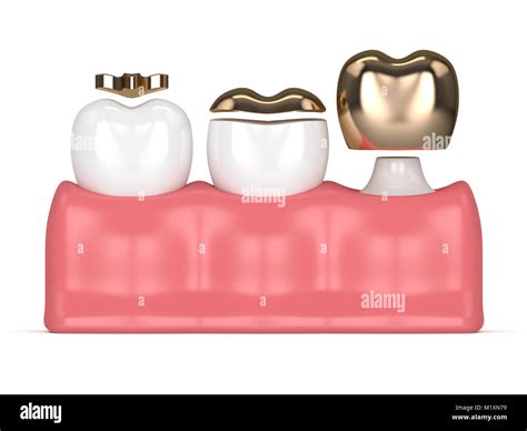 D Render Of Teeth With Inlay Onlay And Crown Gold Filling In Gums