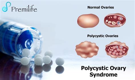 Polycystic Ovary Syndrome - Premilife - Homeopathic Remedies