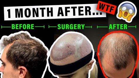 1 Month Results After My Fue Hair Transplant In Istanbul Turkey Youtube