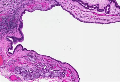 Pathology Outlines Nasopalatine Duct Cyst