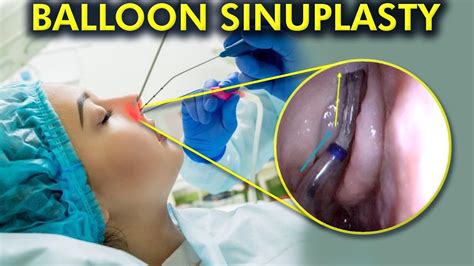 The Balloon Sinuplasty Breakthrough A Painless Path To Clear Sinuses