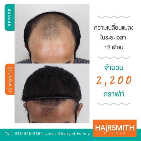 understanding baldness   treatments