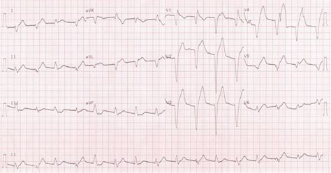 ECG Diagnosis: Accelerated Idioventricular Rhythm The, 42% OFF