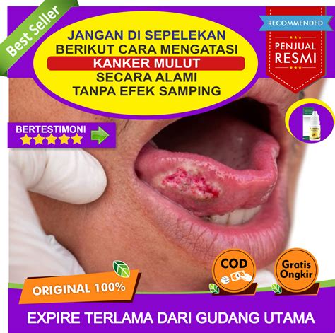 Obat Kanker Rongga Mulut Obat Kumur Kanker Mulut Obat Kanker Mulut