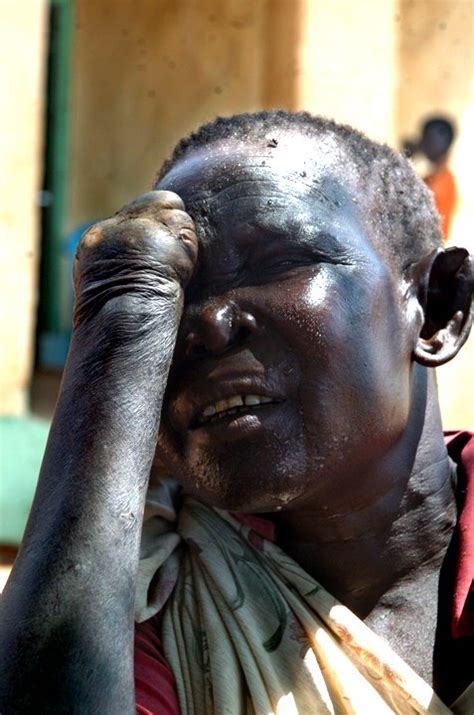 Lepers of Sudan - International Christian Concern