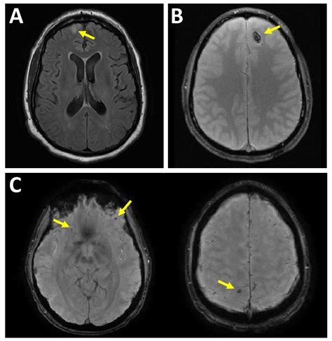 Intra Axial Injury Patterns A Nonhemorrhagic Brain Surface Download Scientific Diagram