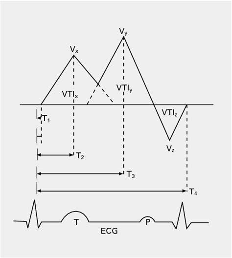 Figure 1 From Transesophageal Doppler Echocardiographic Pattern Of