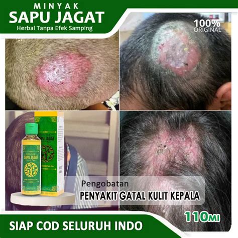 Obat Kulit Kepala Kering Dan Gatal Obat Infeksi Jamur Di Kulit Kepala