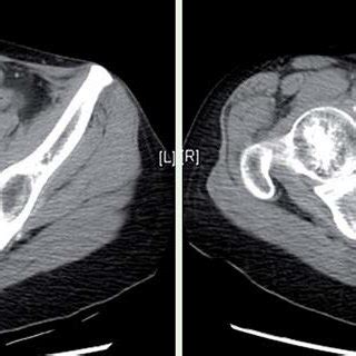 Follow Up Computed Tomography 1 Month Later Showed Complete Resolution