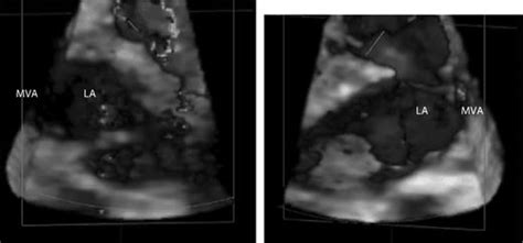 ‘coumadin Ridge In The Left Atrium Demonstrated On Three Dimensional