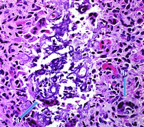 High-power micrograph showing dystrophic calcification (arrow a) and an ...