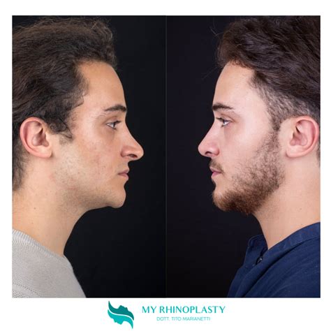 Rinoplastica Cose Da Sapere Prima Dell Intervento My Rhinoplasty