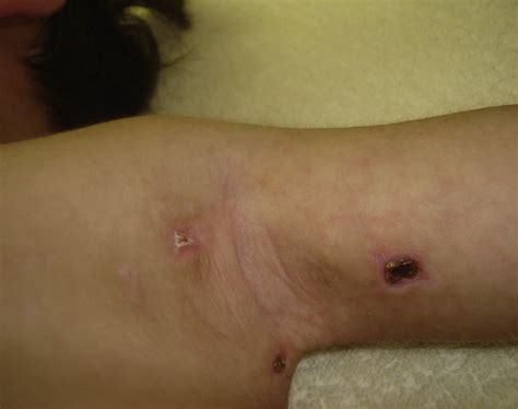 Figure 1 From Axillary Skin Ulcers In Infants With Juvenile